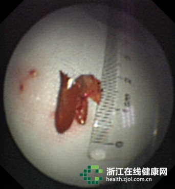 “肺炎”久治不愈竟是嗆進(jìn)氣管辣椒皮惹禍(圖)