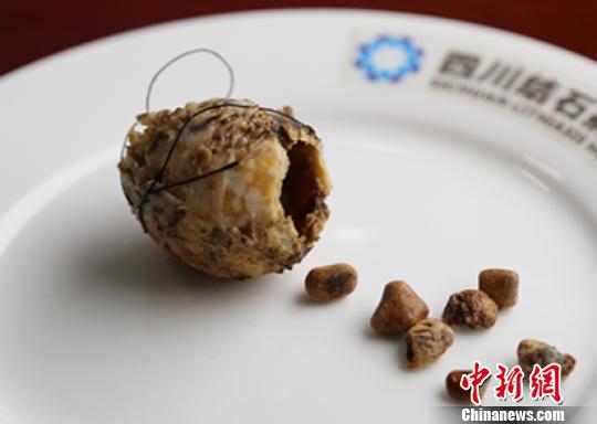 成都85歲老人膽囊變“陶瓷”內(nèi)藏7顆結(jié)石